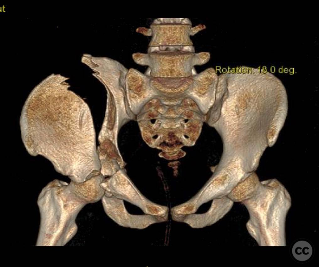 Bilateral SI Joint Disruption and Right Anterior Column Posterior ...