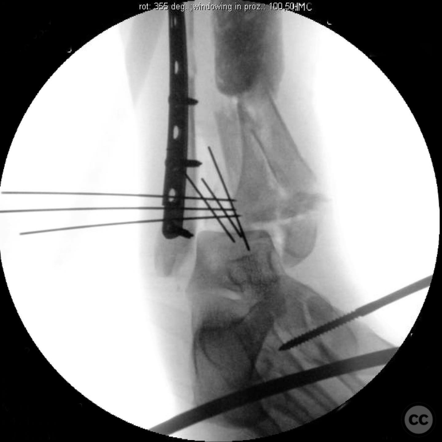 Complex Pilon Fracture with Segmental Bone Loss and Syndesmotic Disruption