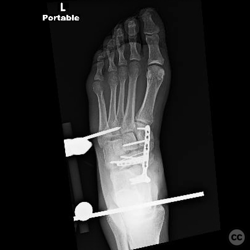 Cuboid Fraqcture Highly Comminuted Navicular Fracture Dislocation with Cuboid Fracture ...