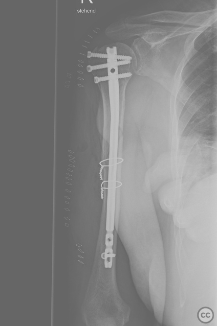 Development and Clinical Application of Percutaneous Compressive Locking Intramedullary  Nail for Humerus