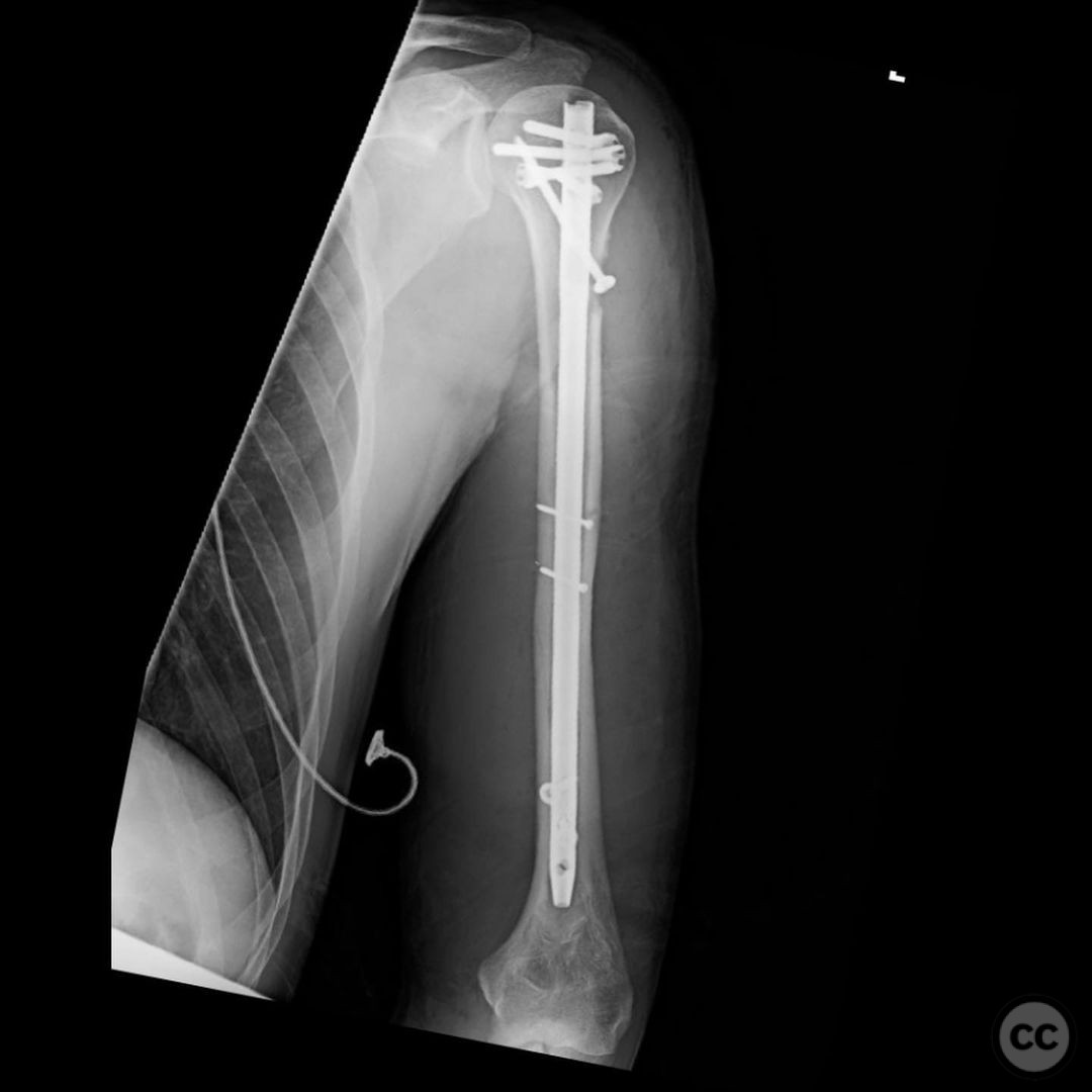 Intramedullary nailing versus a locking compression plate for humeral shaft  fracture (AO/OTA 12-A and B): A retrospective study - ScienceDirect