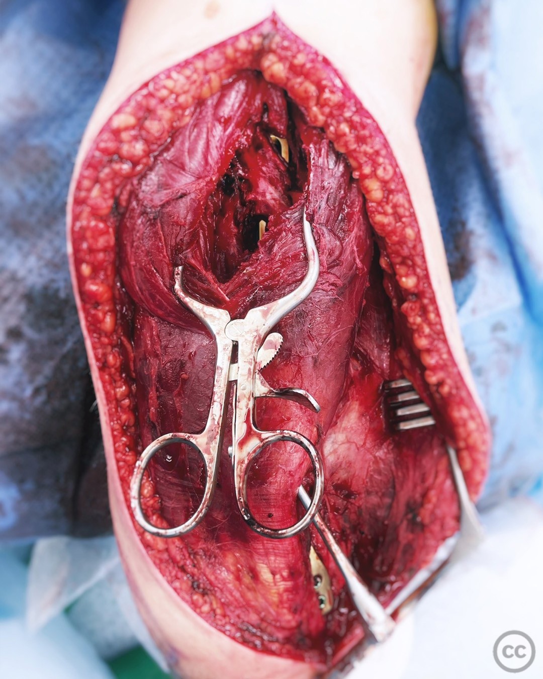 case image