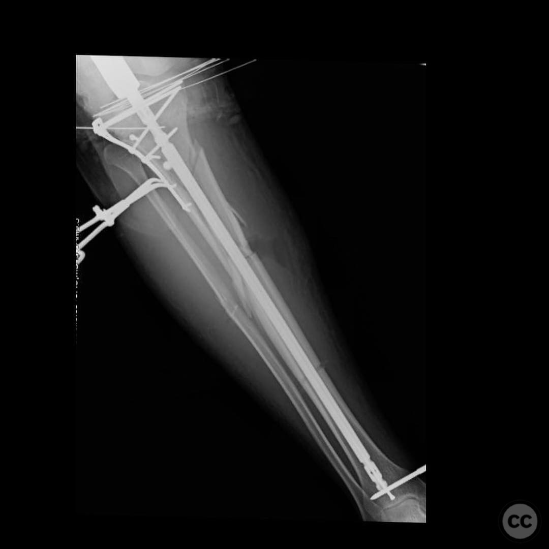 Complex Ipsilateral Tibial Plateau and Shaft Fracture Management in a ...