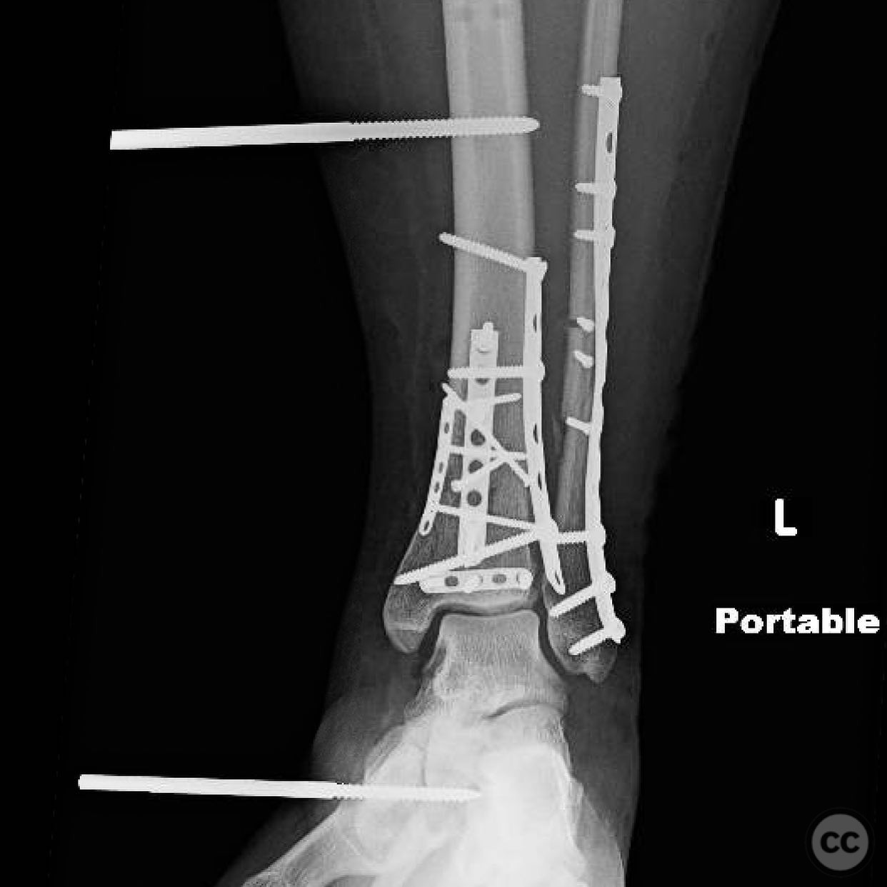 Complex Pilon Fracture with Multiplanar Approach