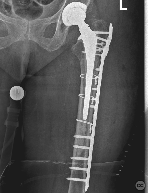 vancouver b2 periprosthetic femur fracture icd 10