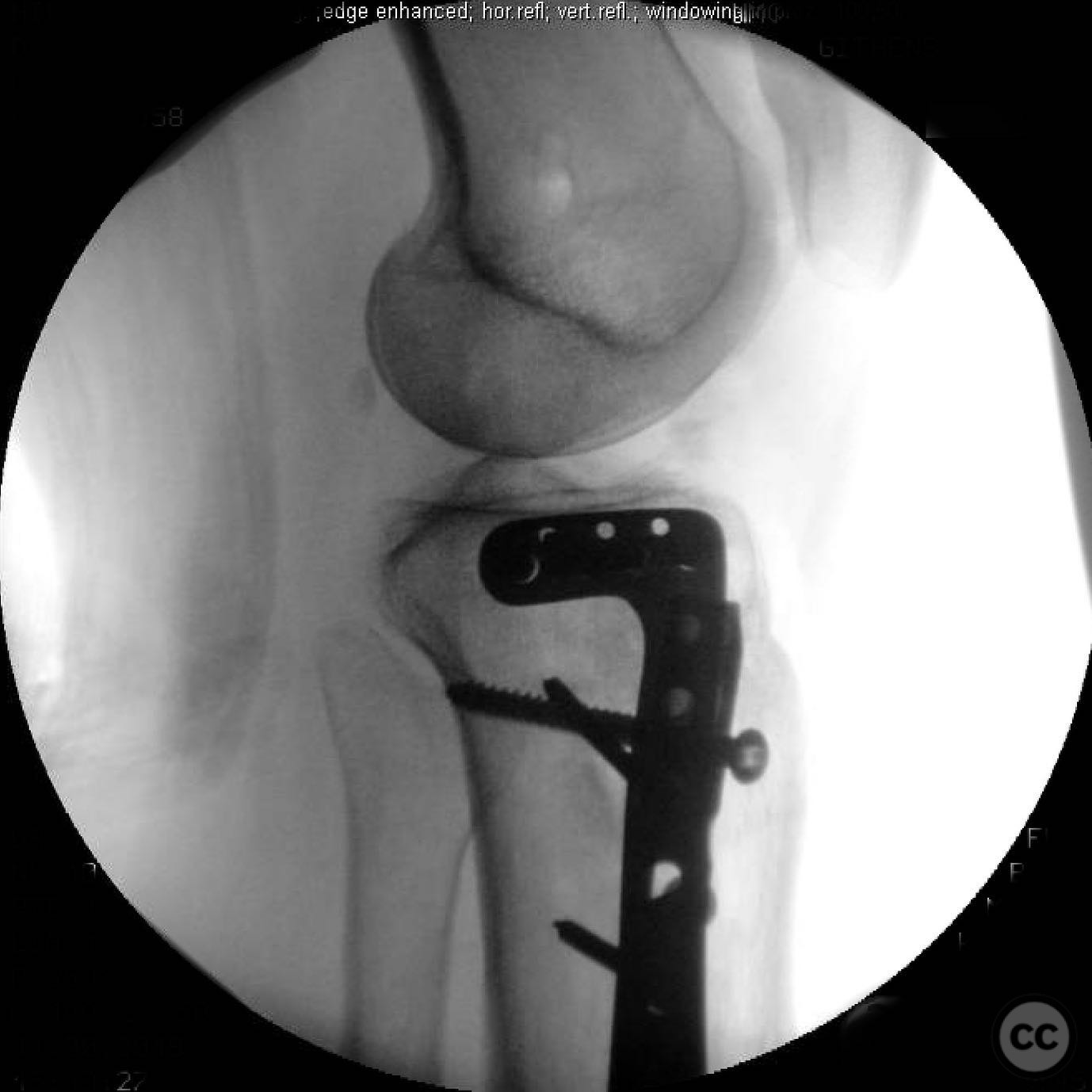 Ipsilateral Tibia AO/OTA 41-B3 Lateral Tibial Plateau Fracture with Ipsilateral Tibial ...