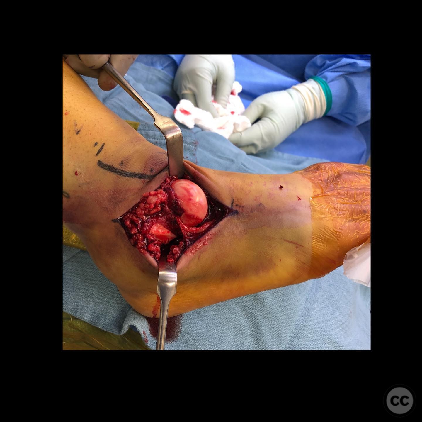 case image