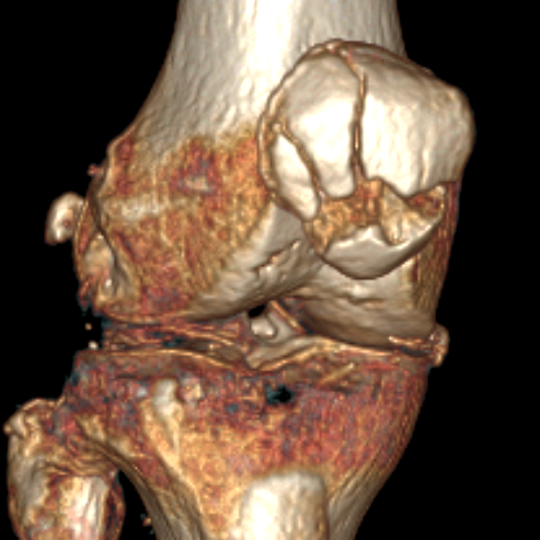 Comminuted patella fracture with retinacular preservation
