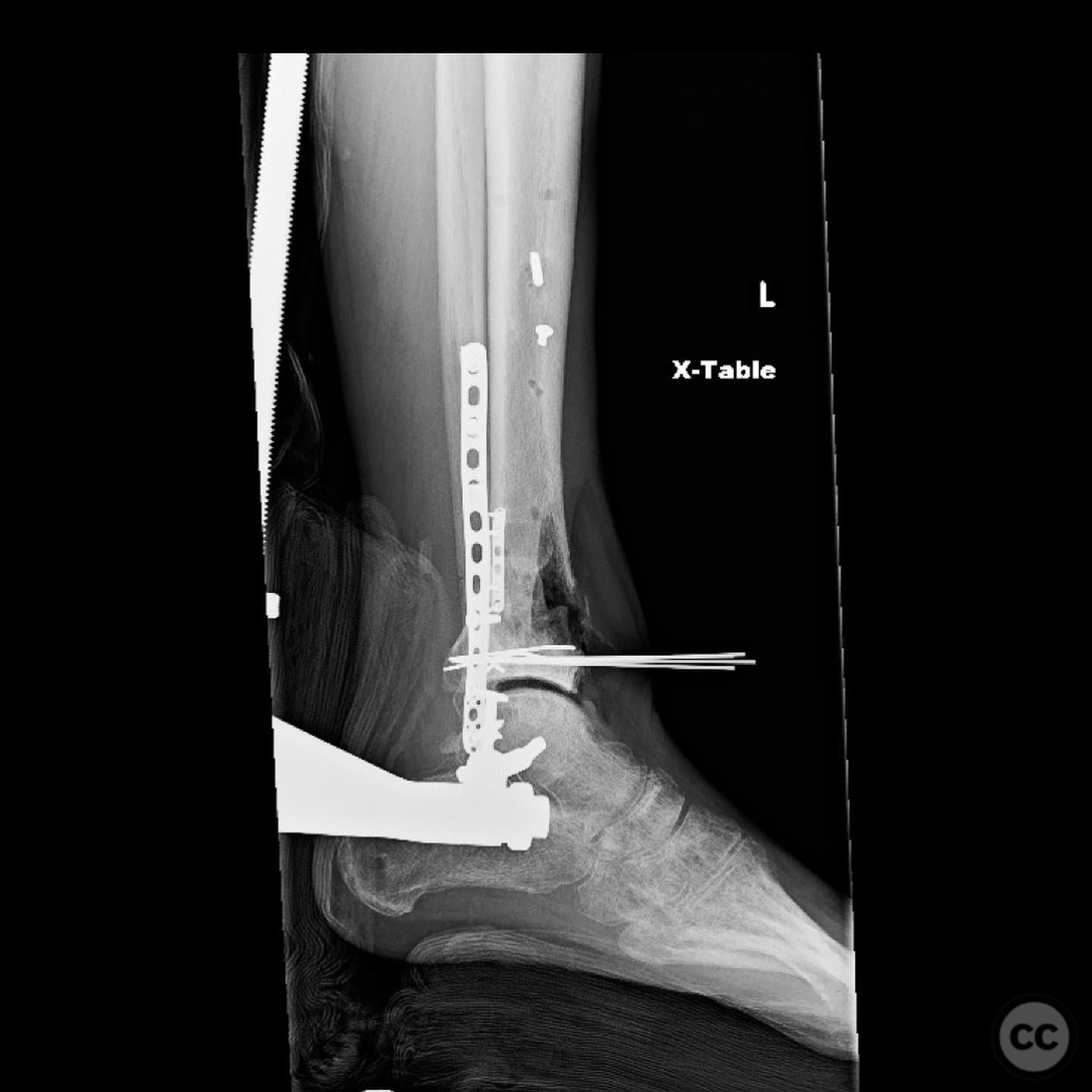 Open Pilon Pilon Nonunion Repair with Deformity Correction
