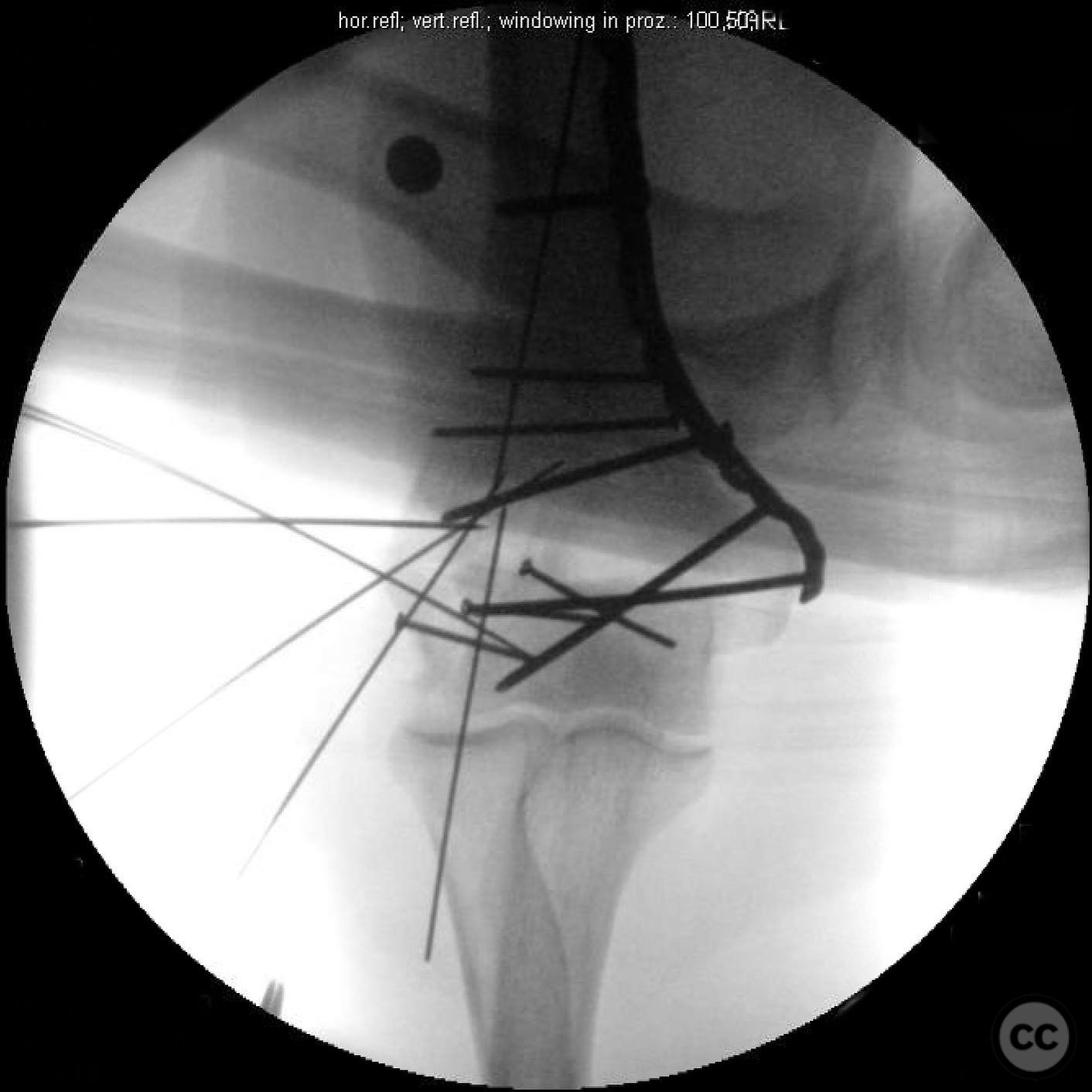Comminuted Capitellum Fracture with Lateral Epicondyle Involvement in a ...