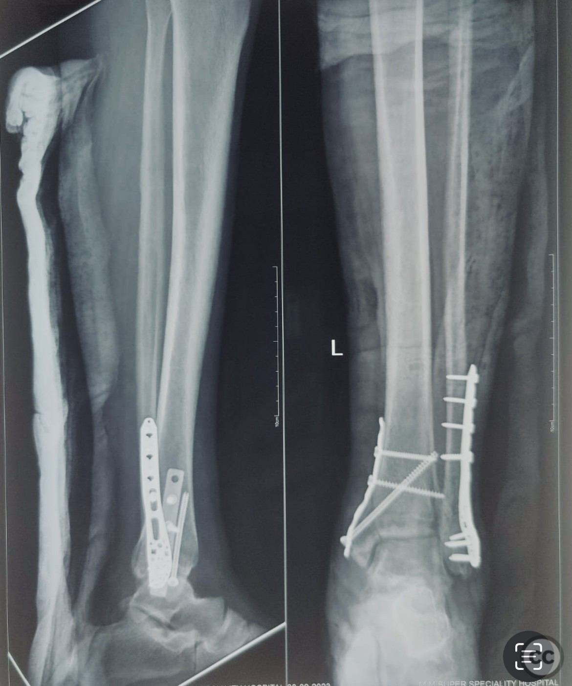 Neglected 2 months Old Bimalleolar Fracture