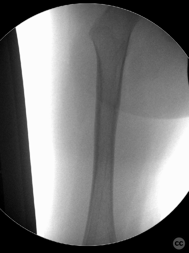 Pediatric Femoral Shaft Fracture Managed with Elastic Stable ...