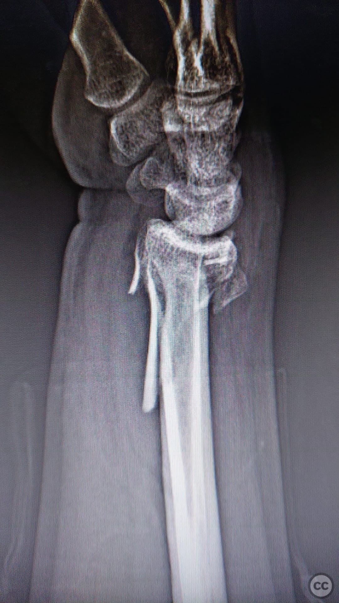Distal Radius And Ulna Styloid Fracture