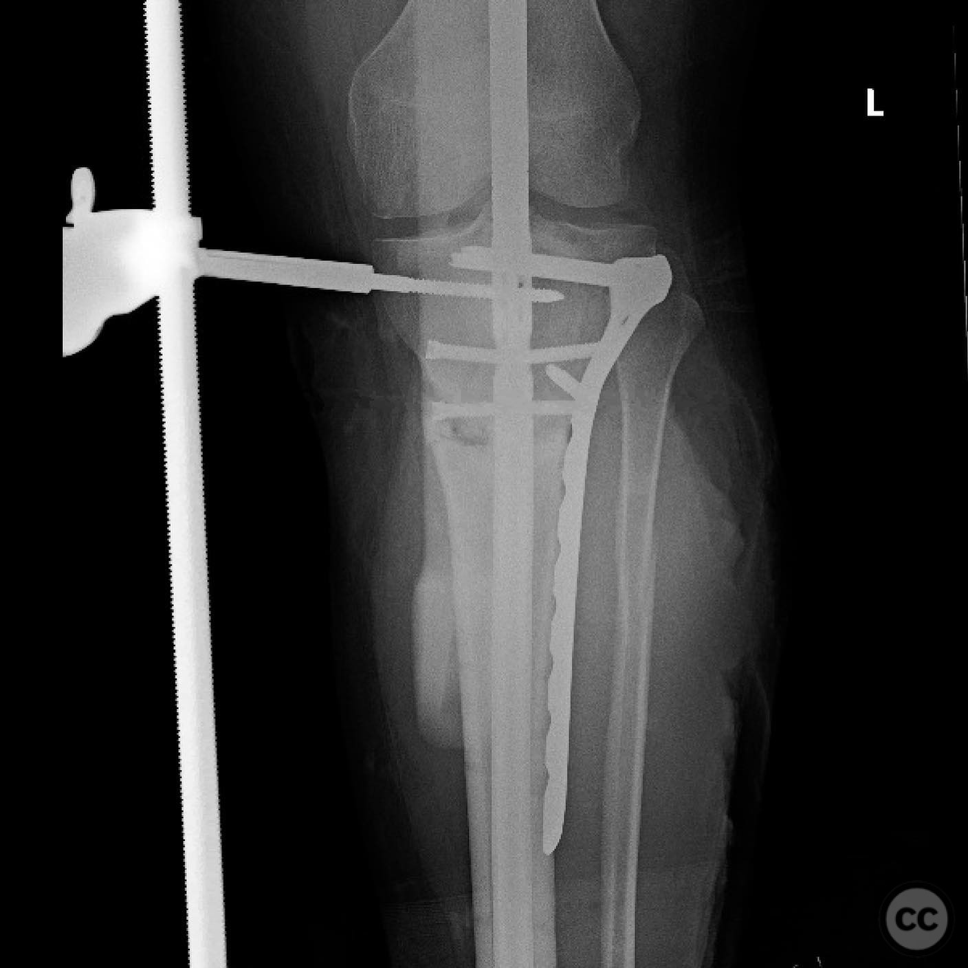 Proximal Tibia Nonunion with Varus Deformity Correction and Stabilization
