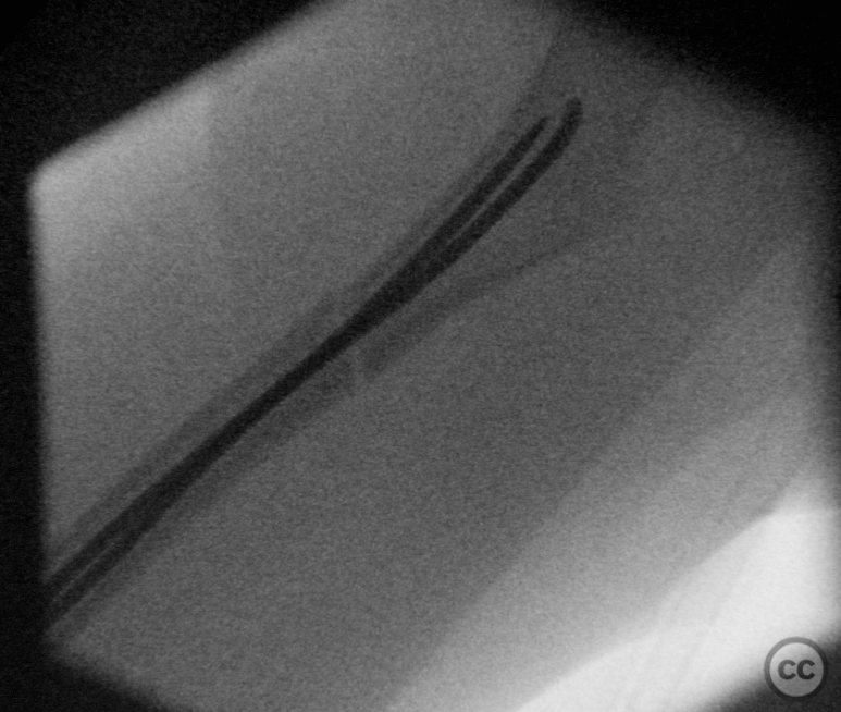 Pediatric Femoral Shaft Fracture Managed with Elastic Stable ...