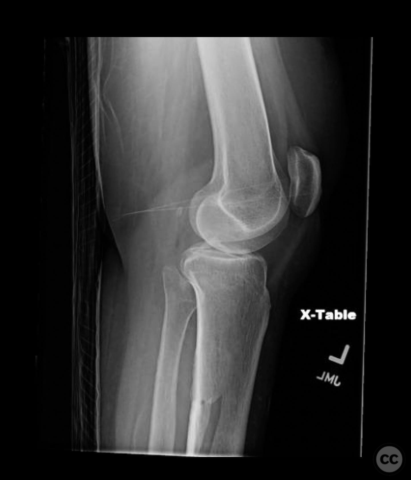 AO/OTA 41-B3 Lateral Tibial Plateau Fracture with Ipsilateral Tibial ...