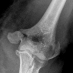 Humerus - AO/OTA 1x