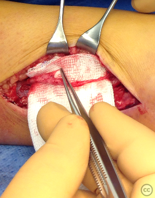 case image