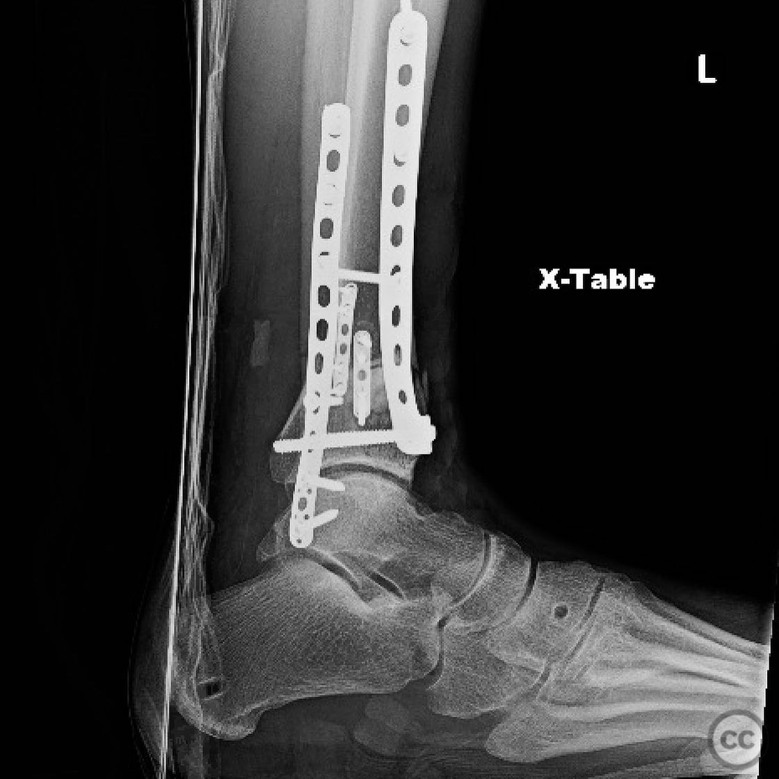 Open Pilon Pilon Nonunion Repair with Deformity Correction