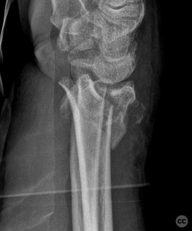 case image