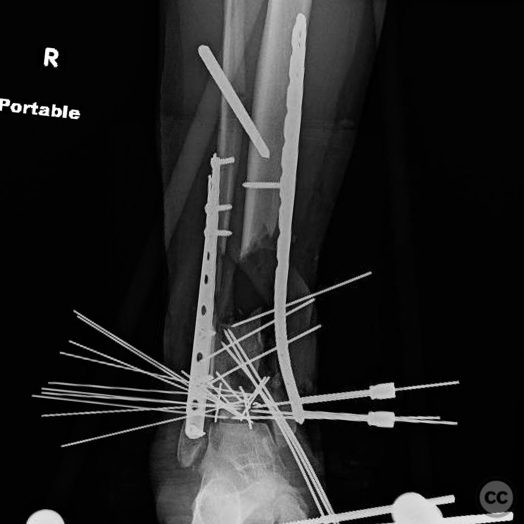 Complex Pilon Fracture with Segmental Bone Loss and Syndesmotic Disruption