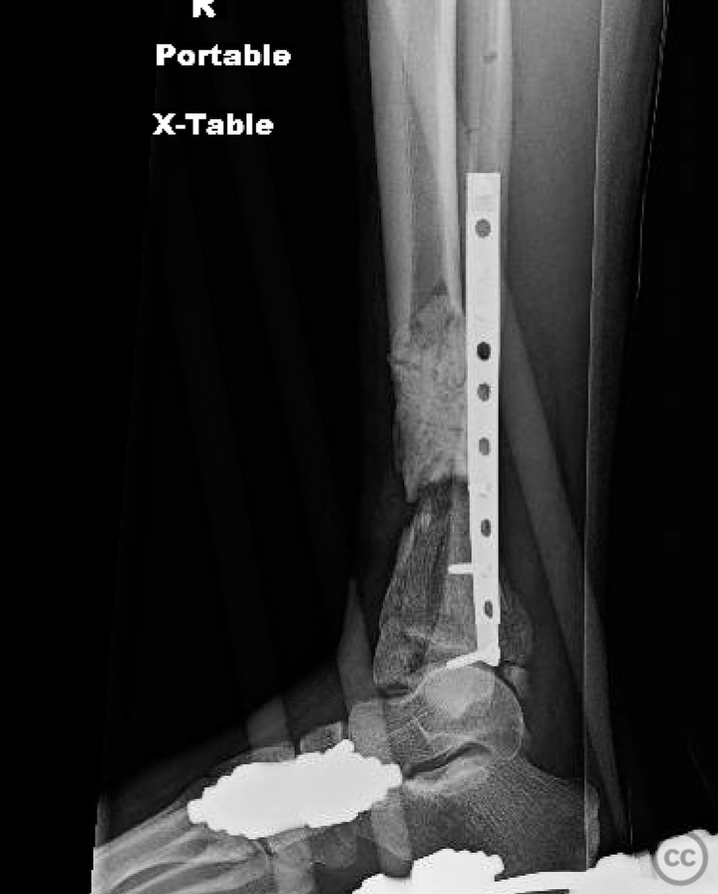 Complex Pilon Fracture with Segmental Bone Loss and Syndesmotic Disruption