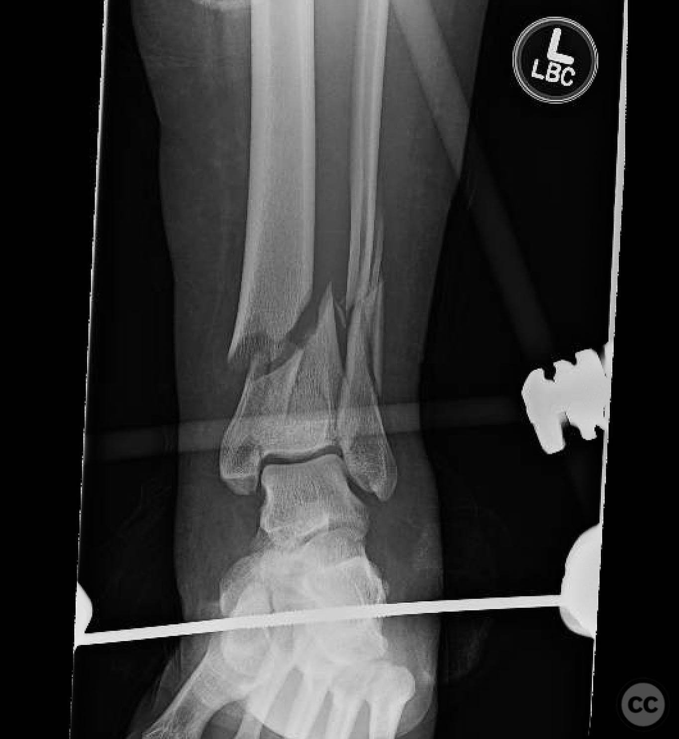 Complex Pilon Fracture with Multiplanar Approach