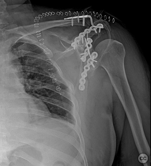 closed fracture of glenoid cavity of left scapula icd 10