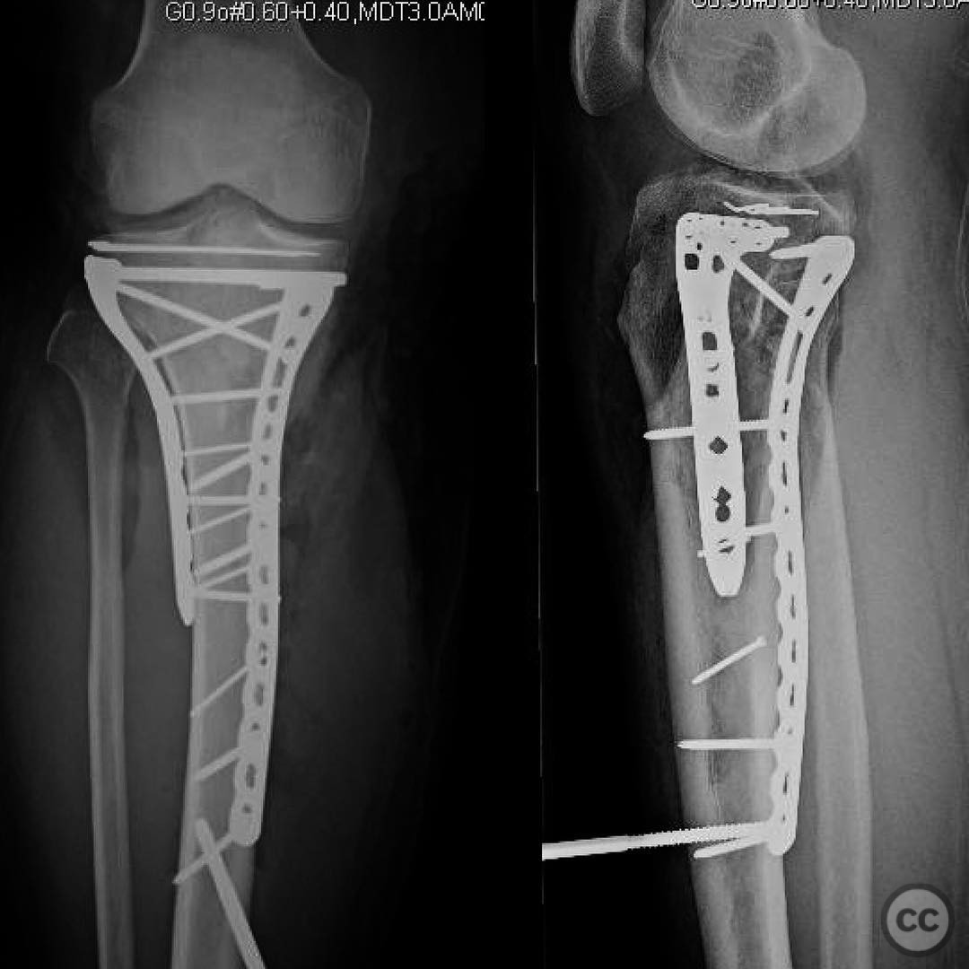 Bicondylar tibial plateau fracture with diaphyseal extension.