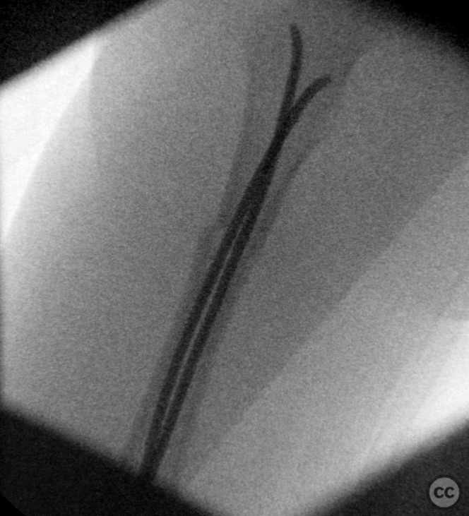 Pediatric Femoral Shaft Fracture Managed with Elastic Stable ...