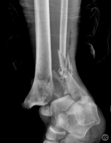 case image