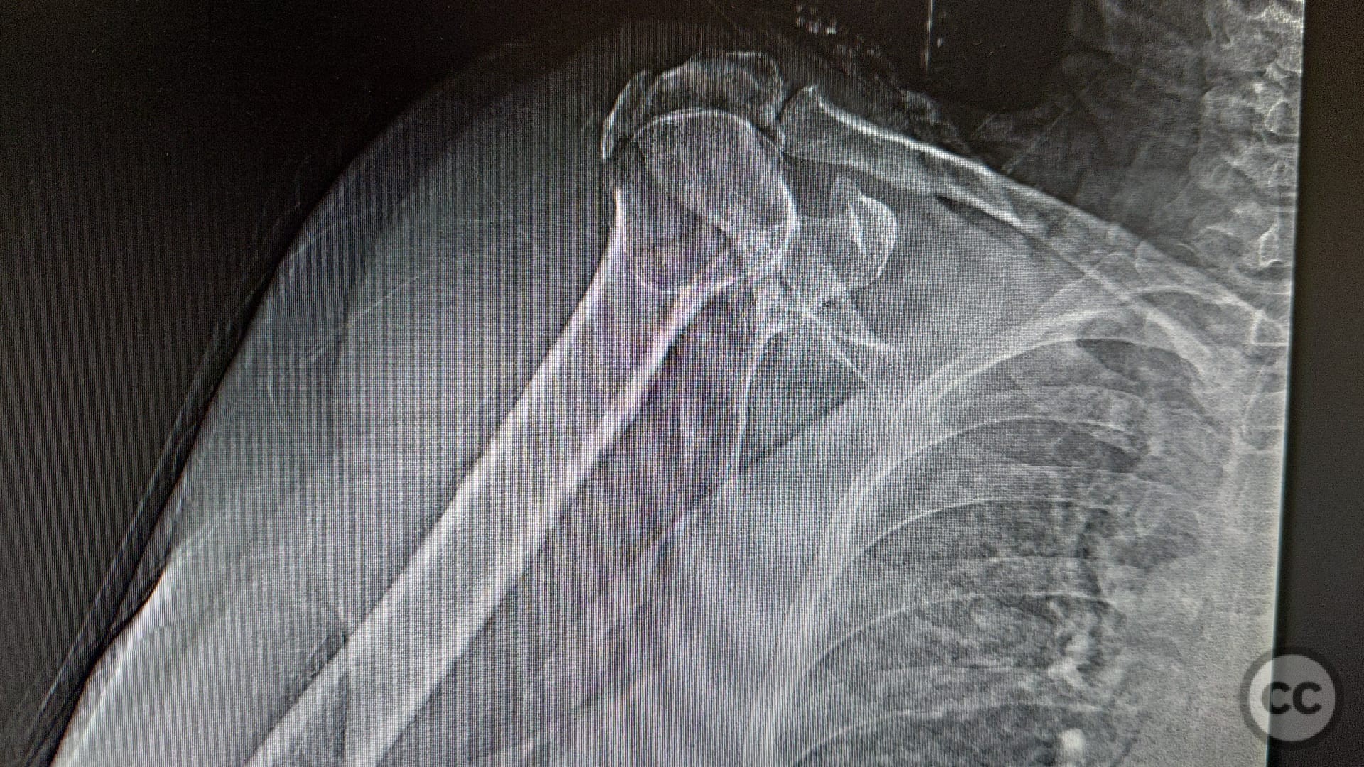 closed 3 part fracture of proximal end of right humerus icd 10