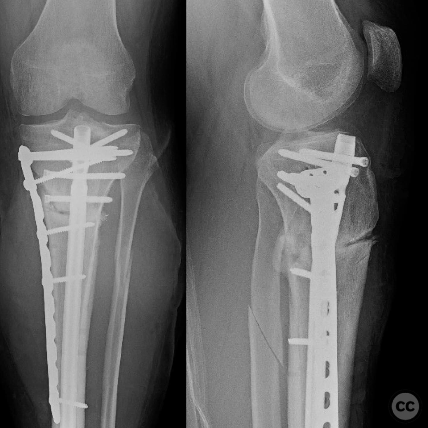 Proximal Tibia Nonunion with Varus Deformity Correction and Stabilization