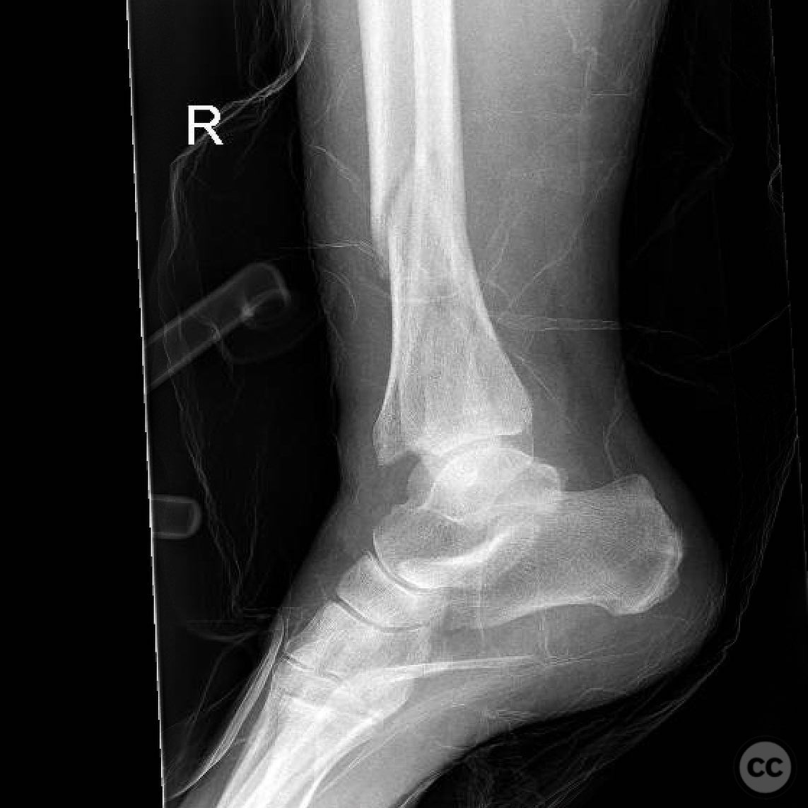 Single Stage ORIF of Low Energy Pilon Fracture in a 59-Year-Old Female