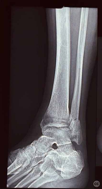 Neglected 2 months Old Bimalleolar Fracture