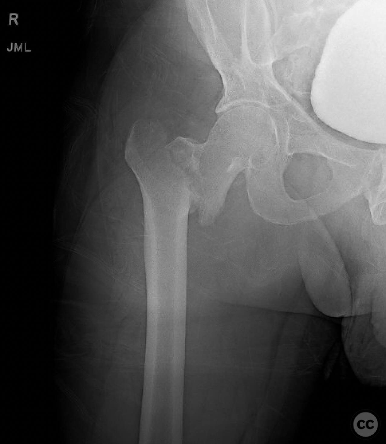 case image