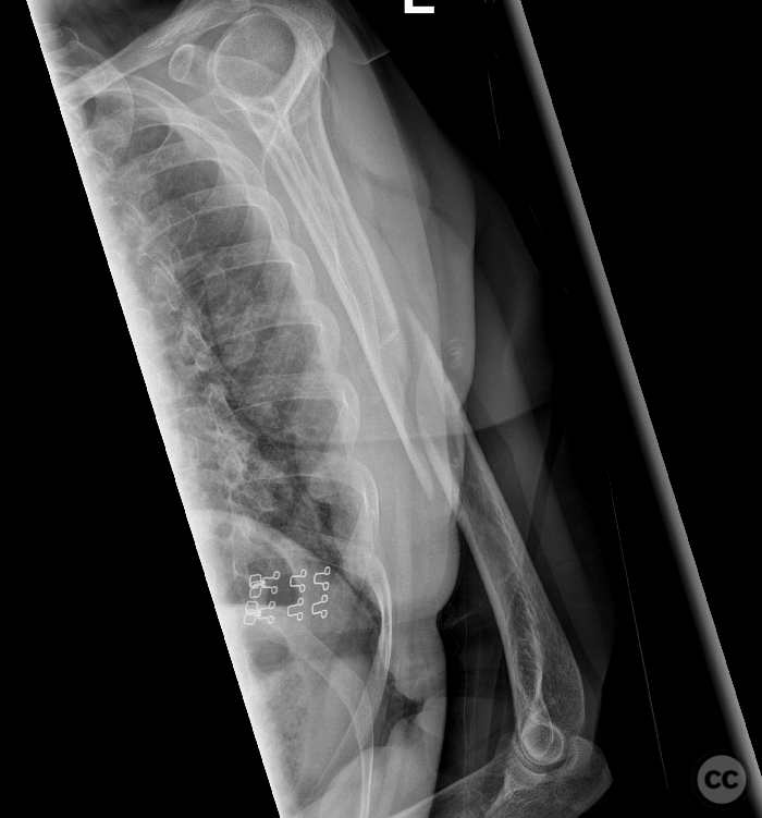 Aggregate lateral approach to a long segmental spiral humerus fracture