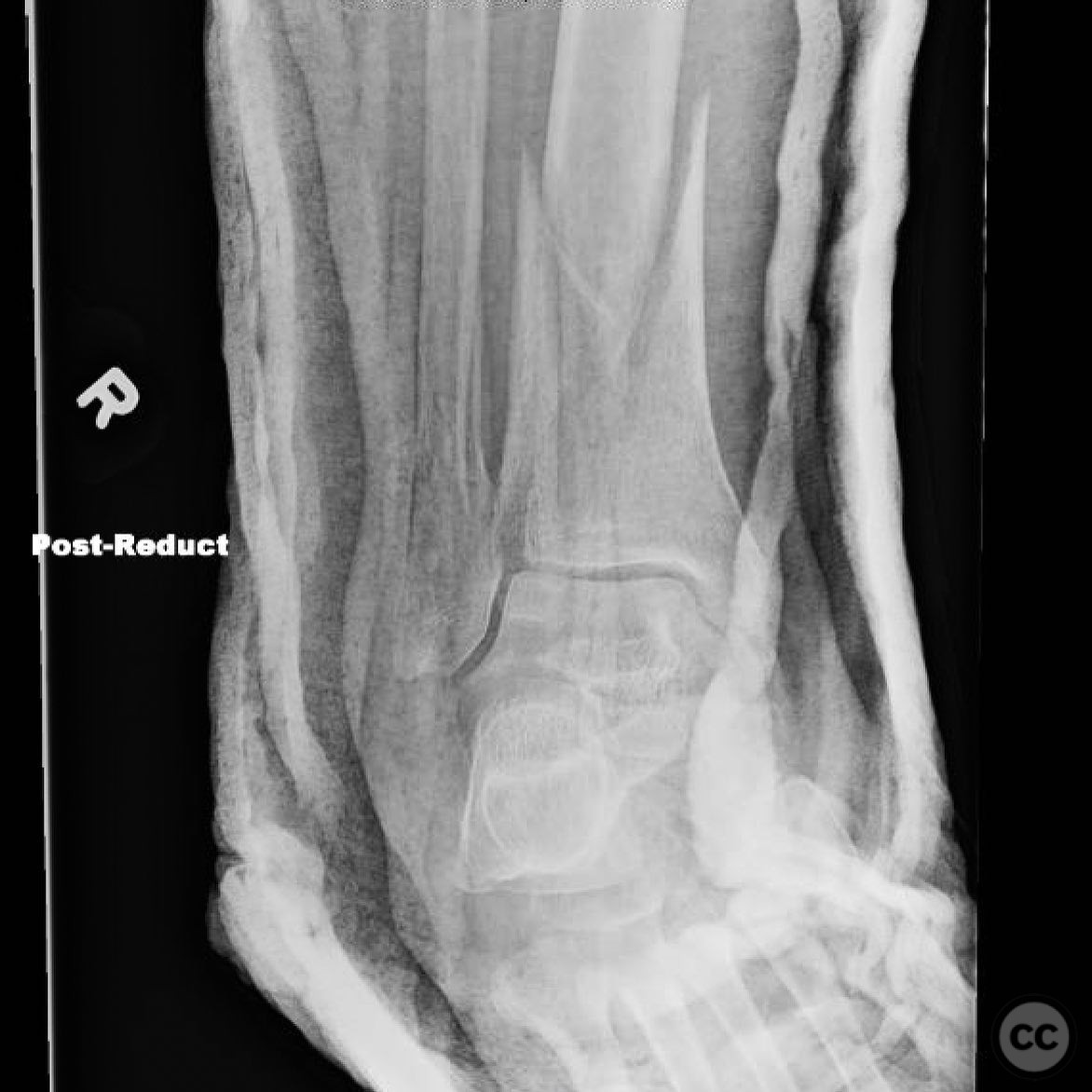 Single Stage ORIF of Low Energy Pilon Fracture in a 59-Year-Old Female