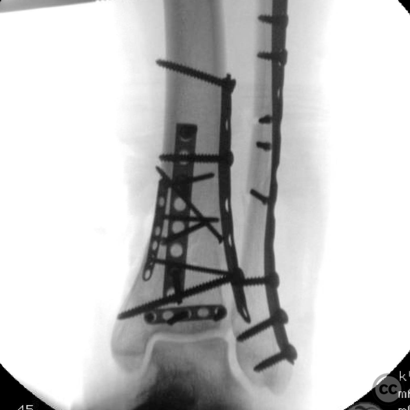 Complex Pilon Fracture with Multiplanar Approach