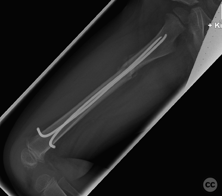 Pediatric Femoral Shaft Fracture Managed with Elastic Stable ...