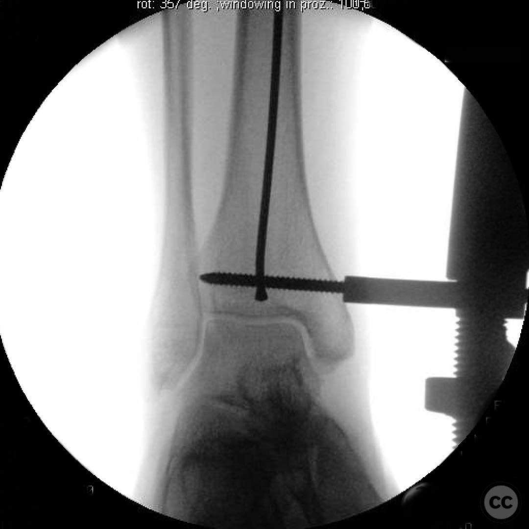 Complex Ipsilateral Tibial Plateau and Shaft Fracture Management in a ...
