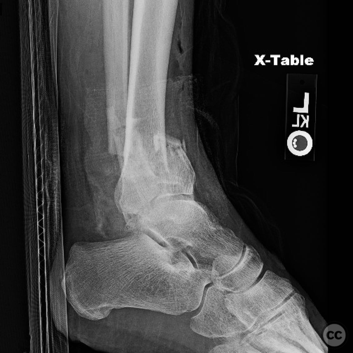 Open Pilon Pilon Nonunion Repair with Deformity Correction
