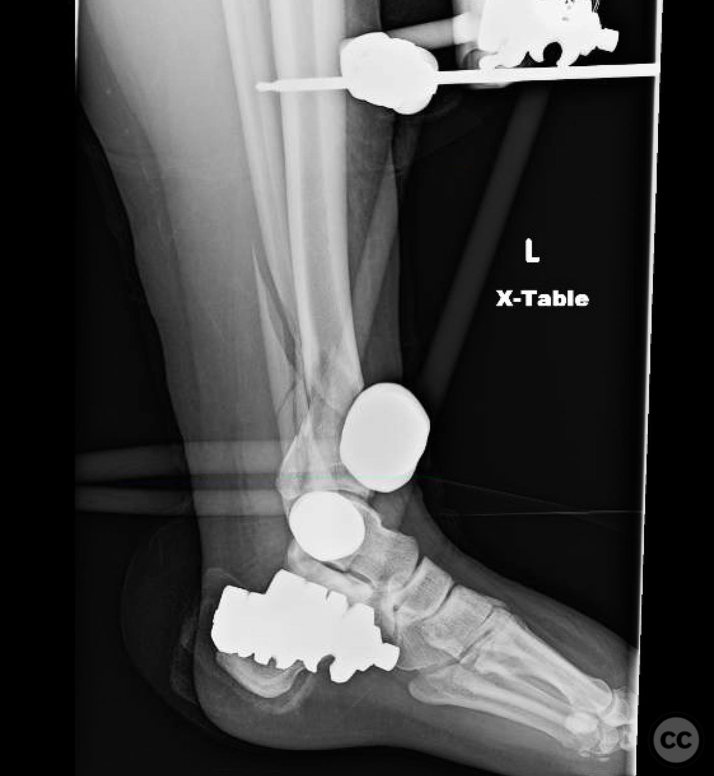 Complex Pilon Fracture with Multiplanar Approach
