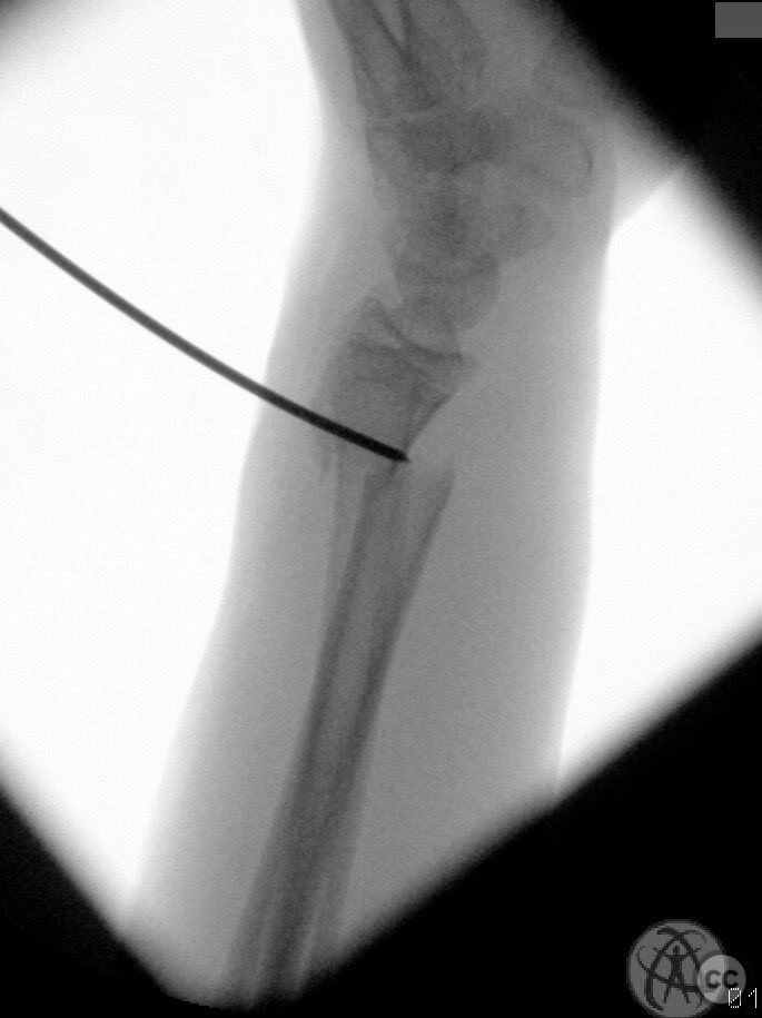 case image