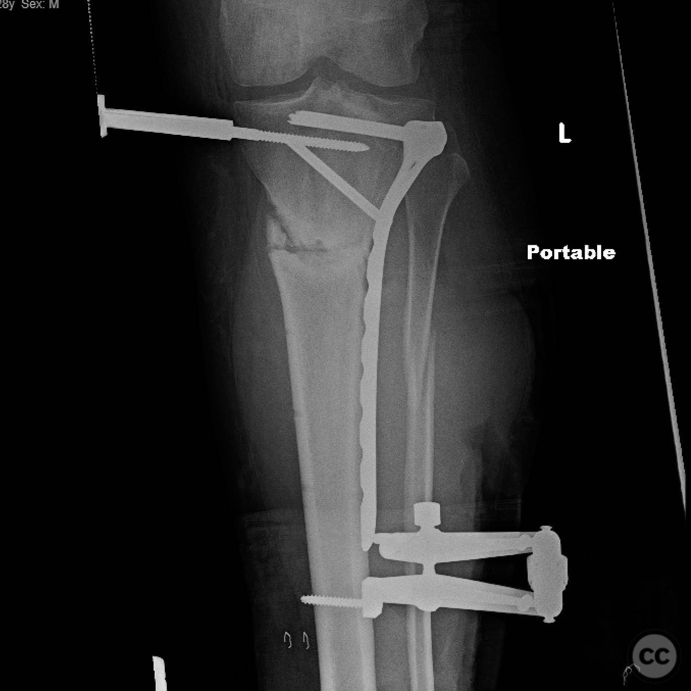 Proximal Tibia Nonunion with Varus Deformity Correction and Stabilization