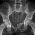 Pelvis - AO/OTA 6x