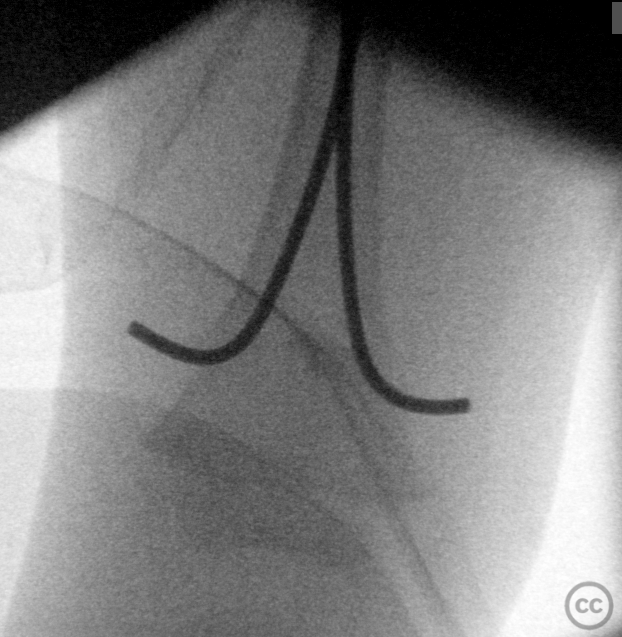 Pediatric Femoral Shaft Fracture Managed with Elastic Stable ...