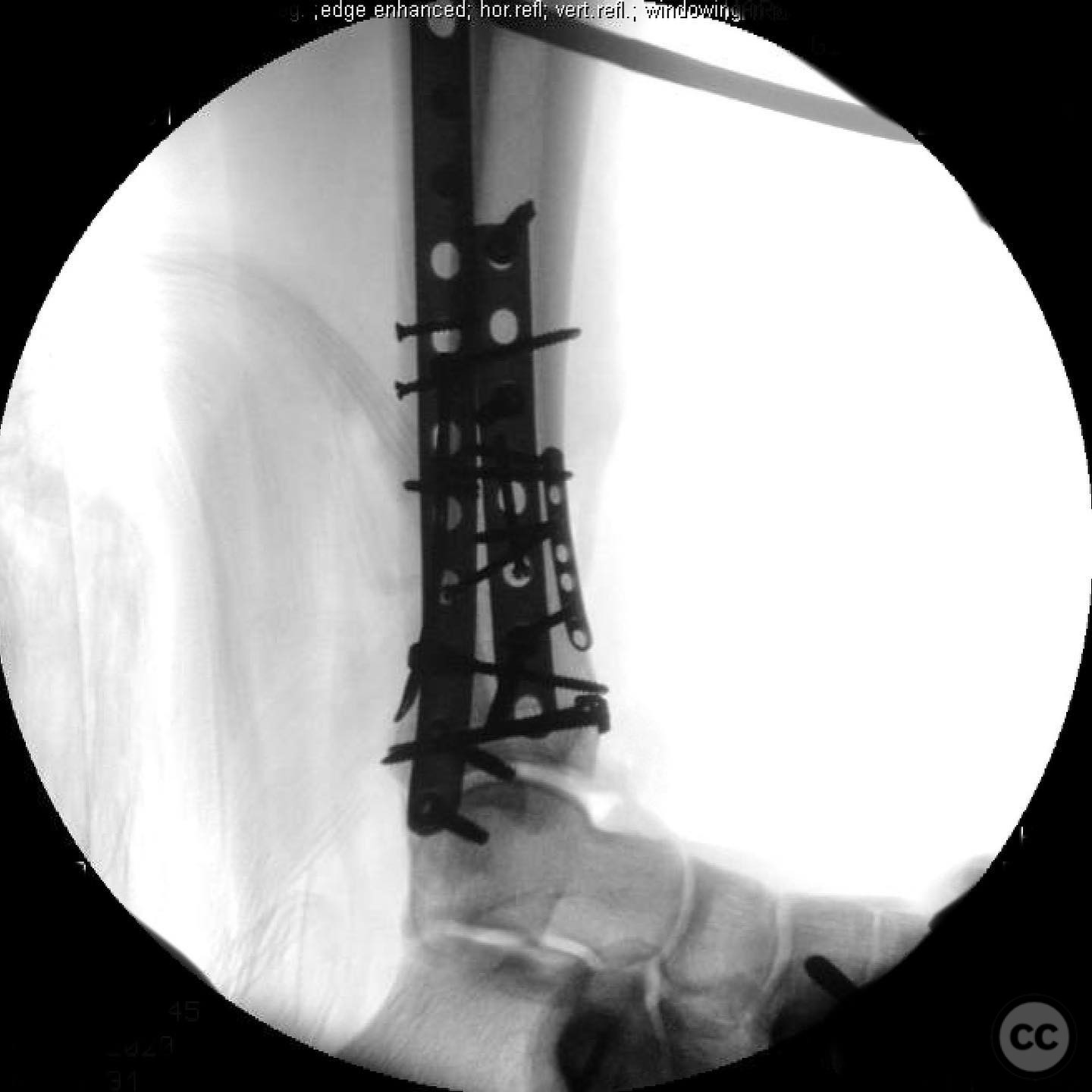Complex Pilon Fracture with Multiplanar Approach