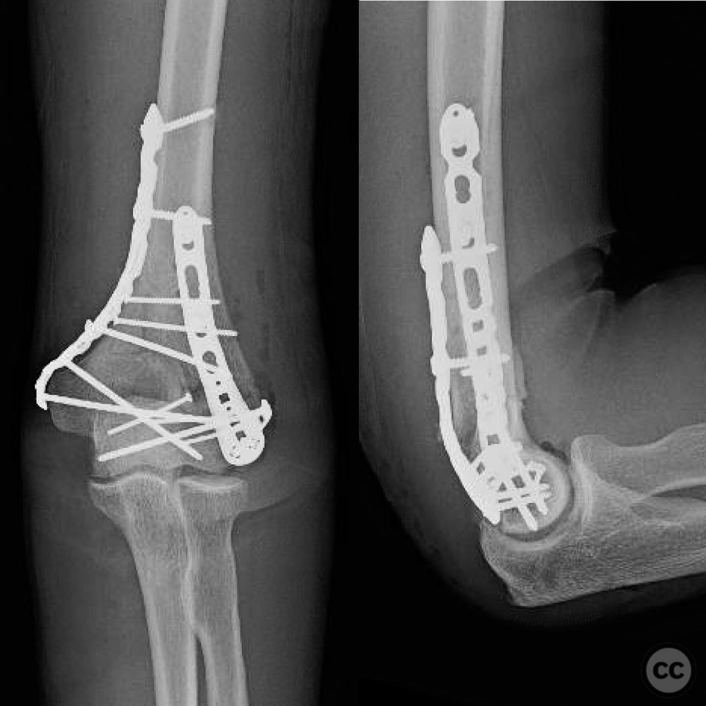 Comminuted Capitellum Fracture with Lateral Epicondyle Involvement in a ...