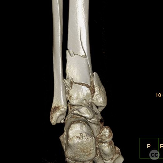 AO/OTA 43-C Type Pilon Fracture with Compartment Syndrome Management